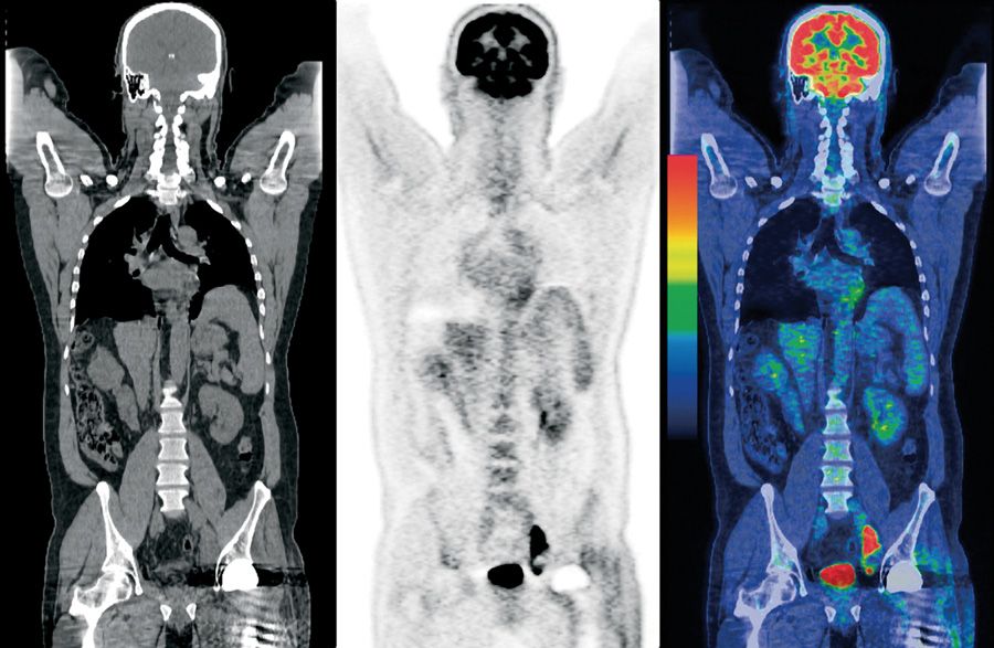 pet-ct